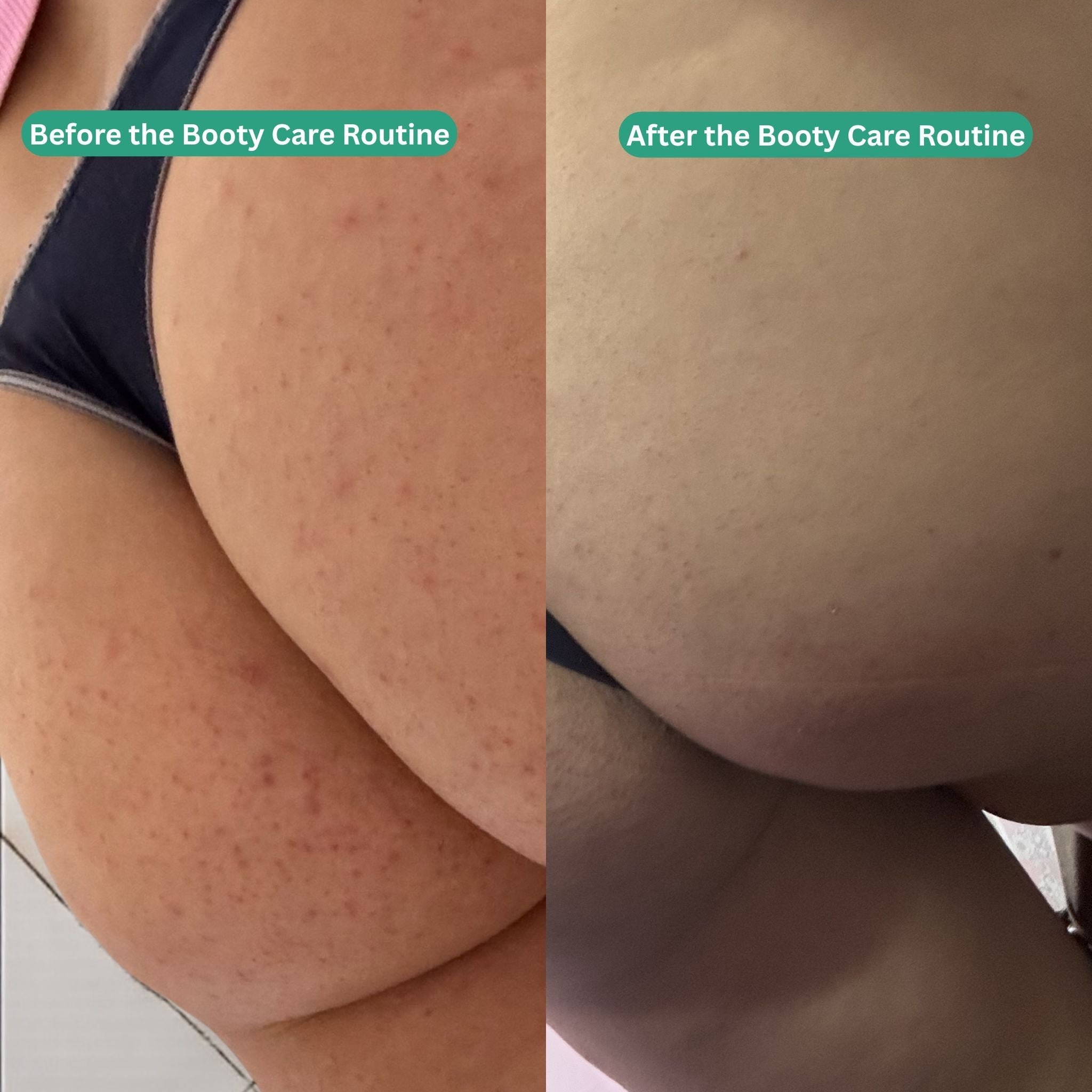 Booty Care Routine - Acne & Hyperpigmentation Treatment - Essentials by Jay