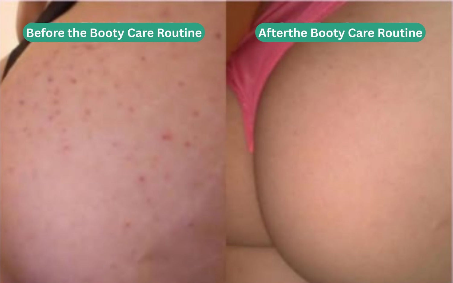 Booty Care Routine - Acne & Hyperpigmentation Treatment - Essentials by Jay