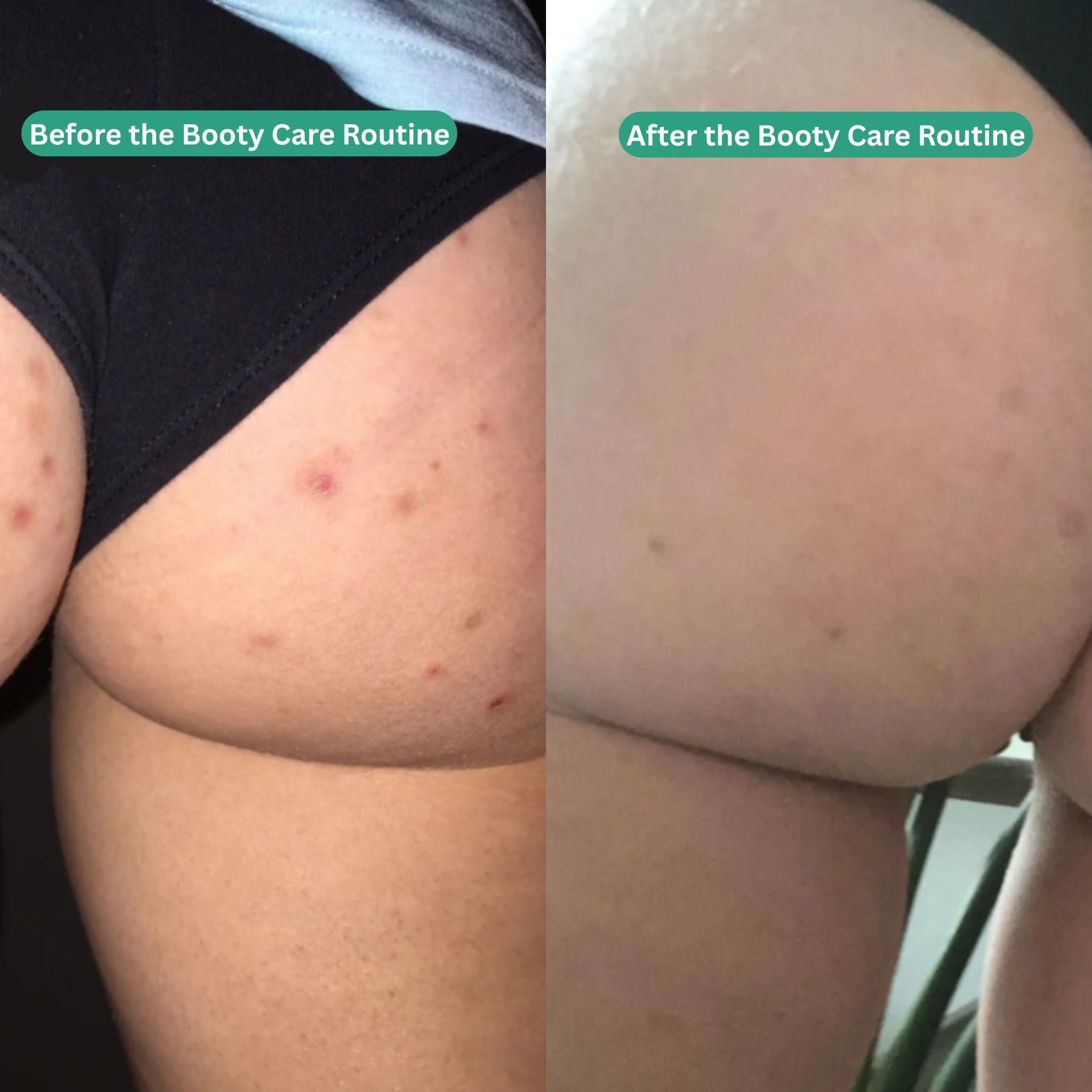 Booty Care Routine - Acne & Hyperpigmentation Treatment - Essentials by Jay