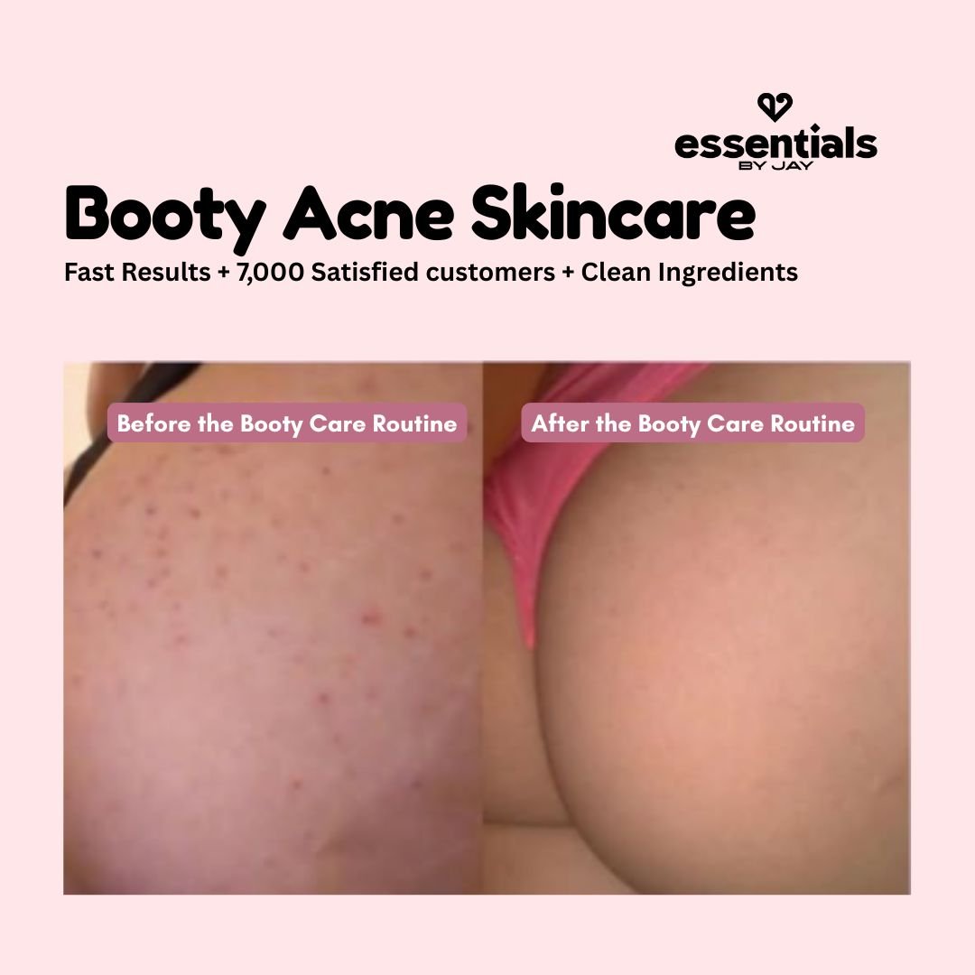 Targeting Butt Acne: The Proven 3-Step Skincare Routine - Essentials by Jay