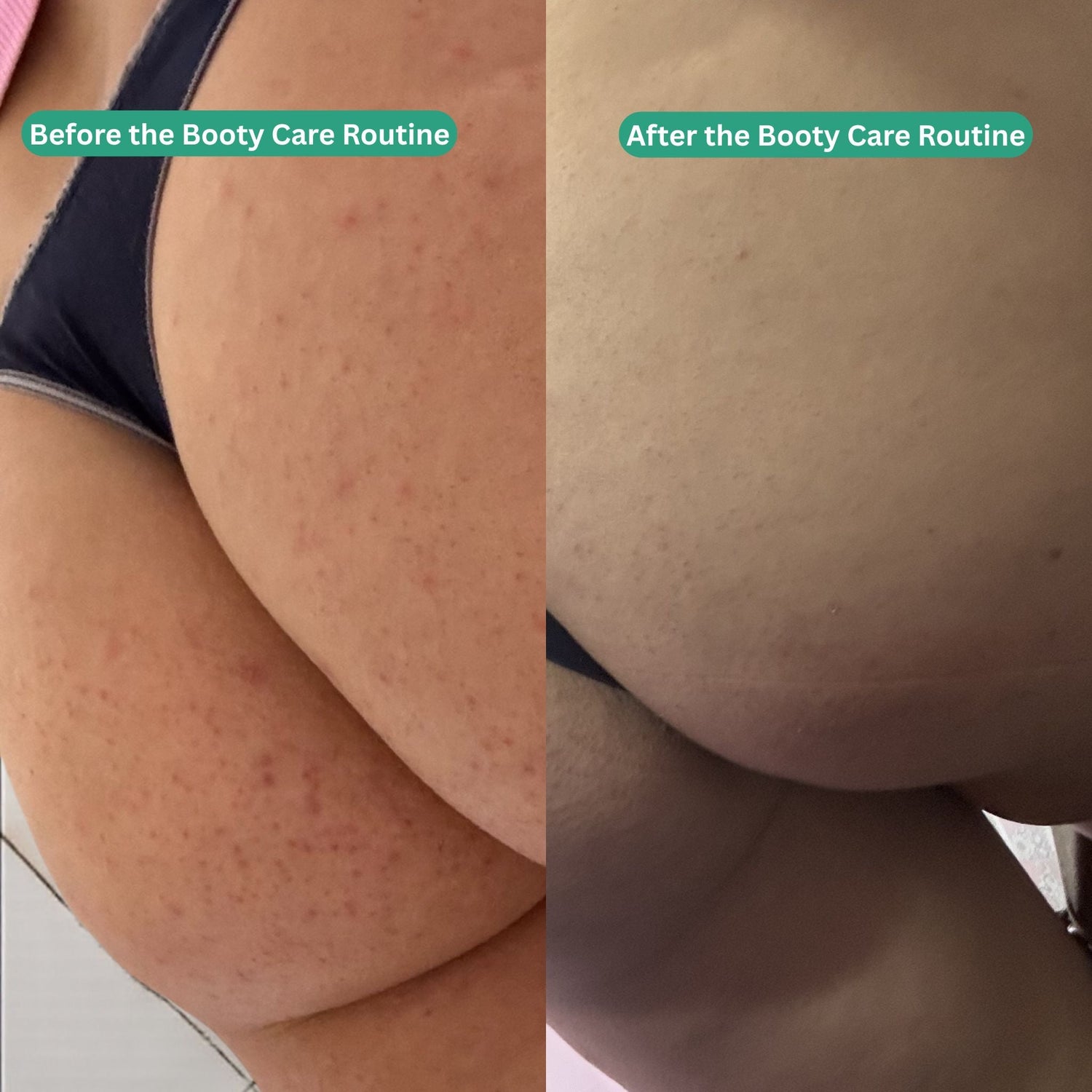 Booty Care Routine - Acne &amp; Hyperpigmentation Treatment - Essentials by Jay
