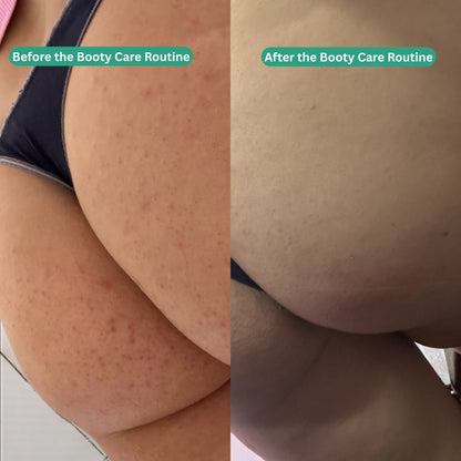 Booty Care Routine - Acne &amp; Hyperpigmentation Treatment - Essentials by Jay