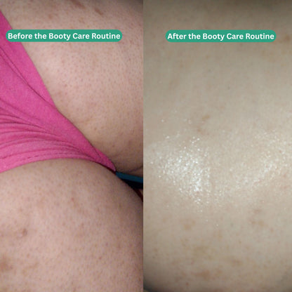 Booty Care Routine - Acne &amp; Hyperpigmentation Treatment - Essentials by Jay