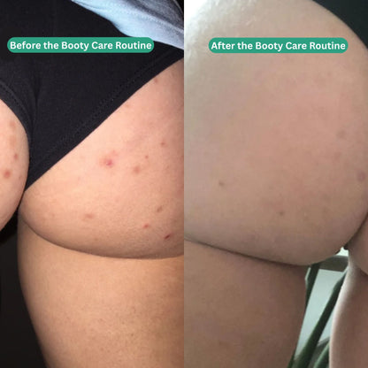 Booty Care Routine - Acne &amp; Hyperpigmentation Treatment - Essentials by Jay